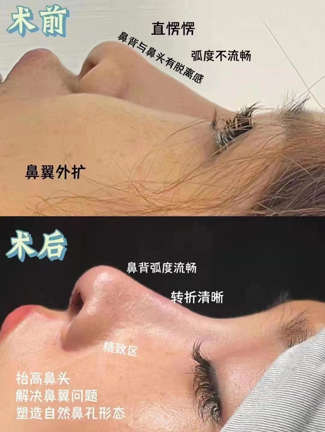 鼻综合整形案列.jpg